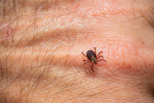 Close-up of a tick on human skin